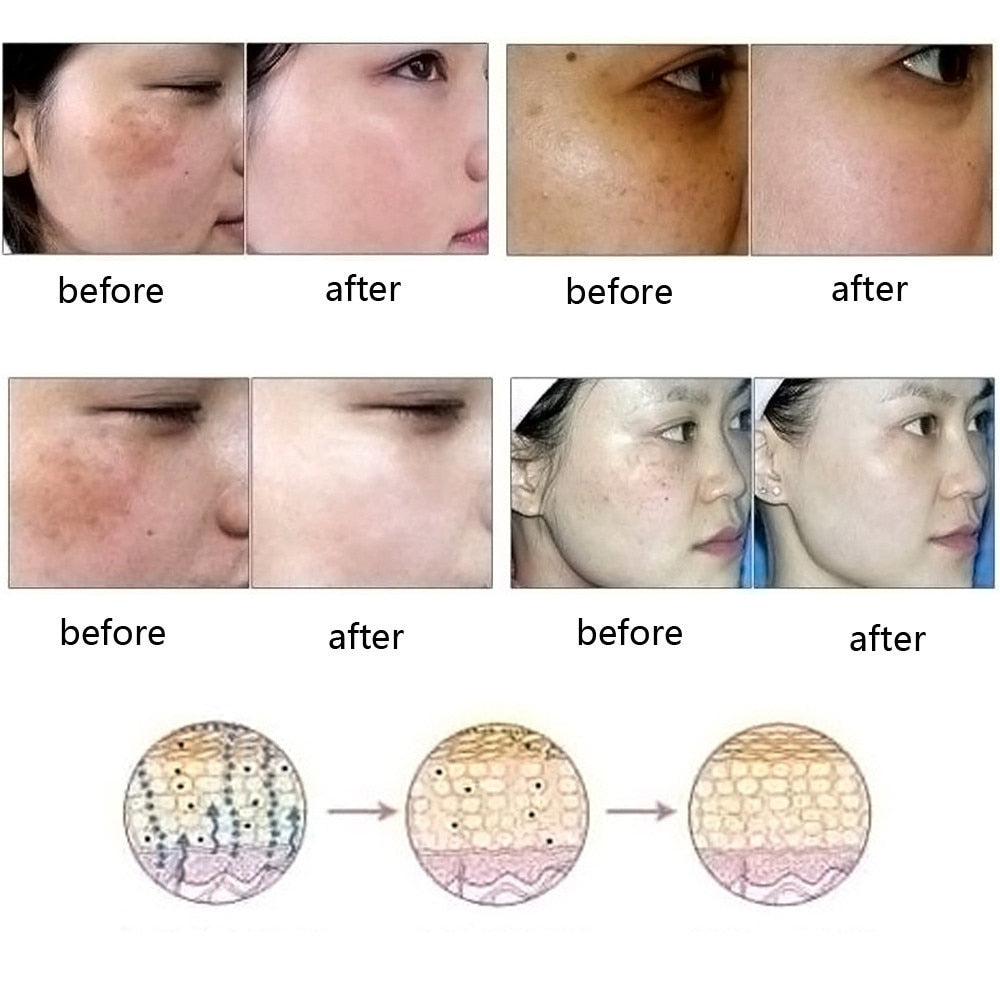 Pure Natural Essence Oil - Removal Acne, Stretch Marks, and Scars