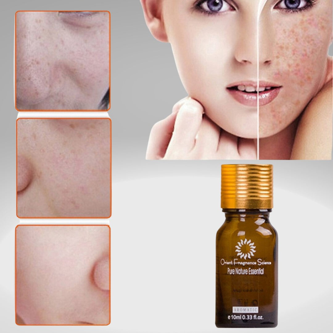 Pure Natural Essence Oil - Removal Acne, Stretch Marks, and  Scars